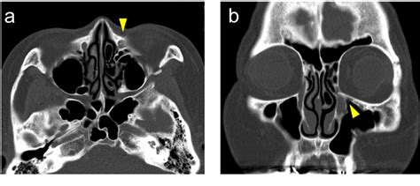 Two Cases Of Nasolacrimal Duct Obstruction Operated By Endoscopic