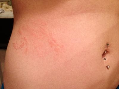 Fungal Skin Rash on Stomach