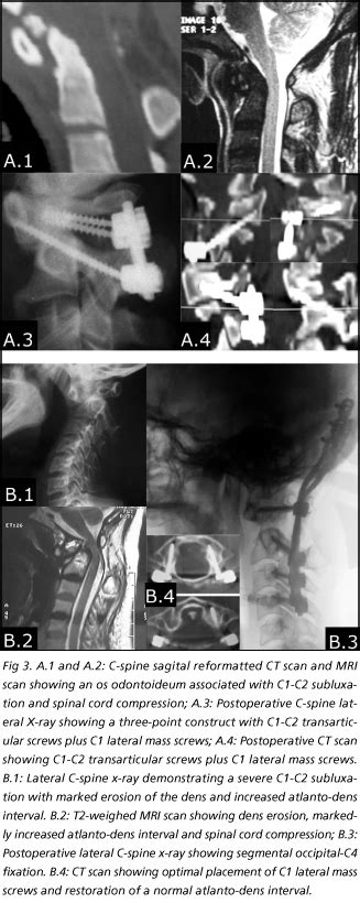 Scielo Brasil C Lateral Mass Screws For Posterior Segmental