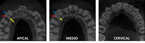 Premolar superior con tres raíces Dento Metric Radiología Dental