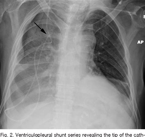 Figure From Recurrent Symptomatic Pleural Effusion Due To A