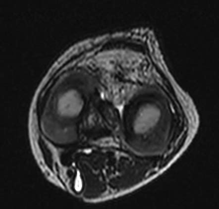 Baker Cyst Radiology Case Radiopaedia Org