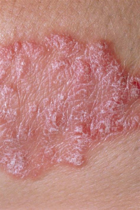 Psoriasis Vs Lupus Similarities And Differences