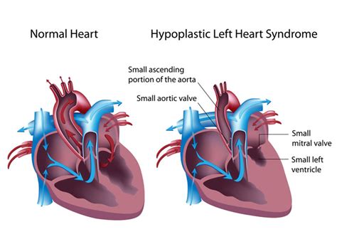 Hypoplastic Left Heart Syndrome