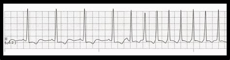 Float Nurse: Practice EKG Strips 372