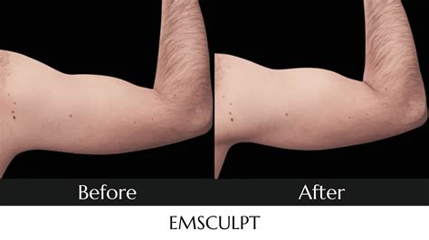 Emsculpt