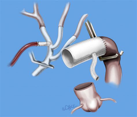 The Descending Aorta Is Controlled Either With A Clamp Endoluminal