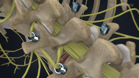 TLIF Surgery - Transforaminal Lumbar Interbody Fusion in Florida