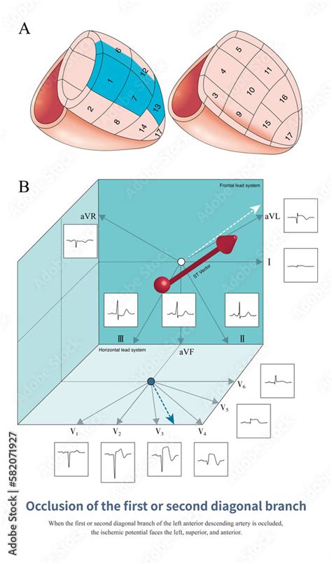 When The First Or Second Diagonal Branch Of The Left Anterior