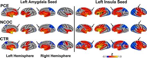 Prenatal Drug Exposure Affects Neonatal Brain Functional Connectivity