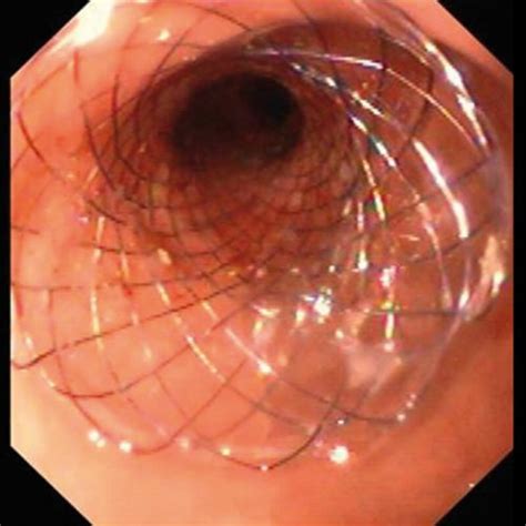 Duodenum Stents Micro Tech Europe