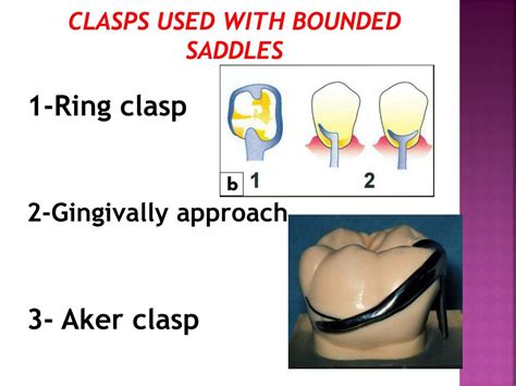 Partial Denture Clasp Types