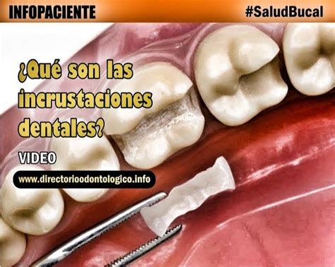 INFOPACIENTE Qué son las Incrustaciones Dentales