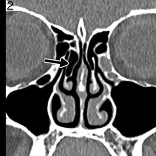 Bolguer classification of the concha bullosa: (1) bulbous concha ...