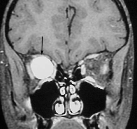 Glioma: Symptoms Of Optic Glioma