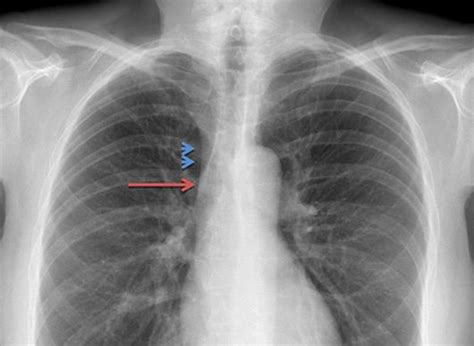 Figure From Superior Vena Cava Syndrome In A Patient With Small Cell