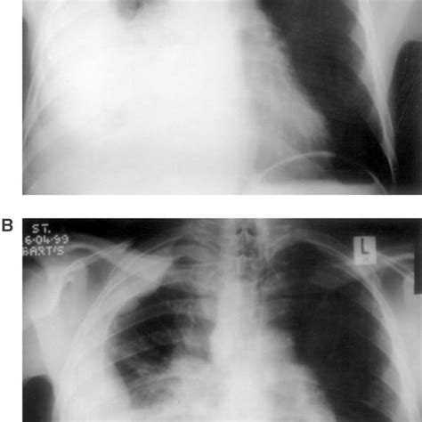 Chest Radiograph Prior And Post Ipm Therapy Download Scientific Diagram