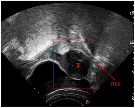 Healthcare Free Full Text Automated Uterine Fibroids Detection In