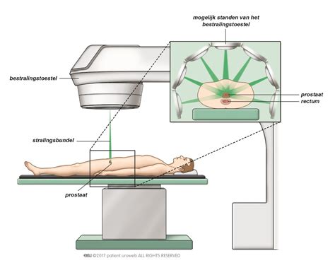 Zorgpad Prostaatkanker Alles Over Urologie