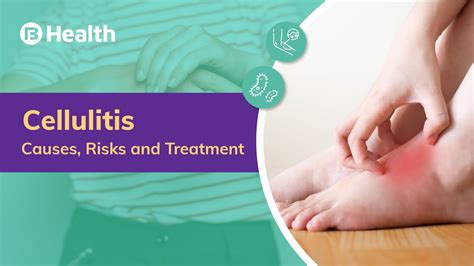 What Is Cellulitis Causes Symptoms Diagnosis And Treatment