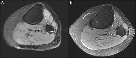 A Preoperative T2 Weighted Axial Mr Image At The Level Of The Fibular Download Scientific