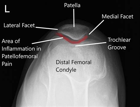 Knee Muscle Anatomy Mri : The Radiology Assistant Shoulder Anatomy Mri ...