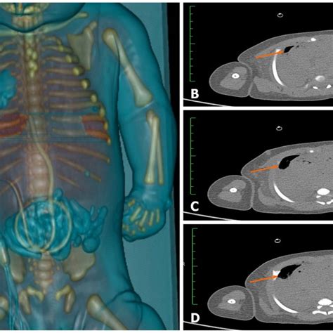 Results Of Imaging Examination A Total Body Postmortem Computed