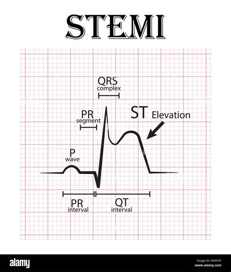 Ecg De Infarto De Miocardio Con Elevación Del St Stemi Y Detalle De