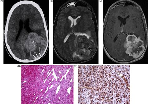 Intracranial Solitary Fibrous Tumor Imaging Findings European