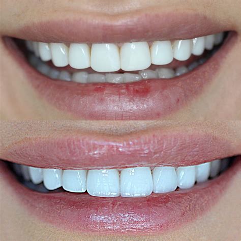 Porcelain And Composite Veneers Hamilton Tulip Dental