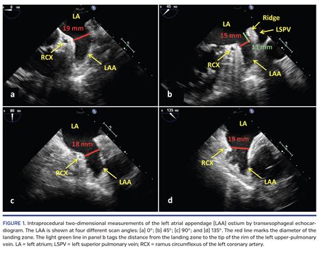 Improved Algorithm For Ostium Size Assessment In Watchman Left Atrial