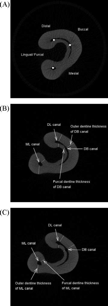 Evaluation Of A Rotary Instrumentation Method For C Shaped Canals With