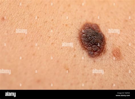 Close Up Picture Of Dangerous Brown Nevus On Human Skin Melanoma