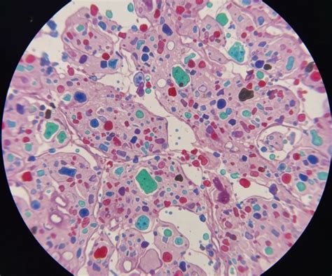 global alarms microplastics  deep  human organs