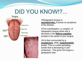 Geographic tongue disease powerpoint