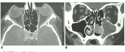 Lamina Papyracea Of The Ethmoid Bone