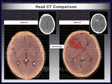 Head Ct Comparison Trialquest Inc