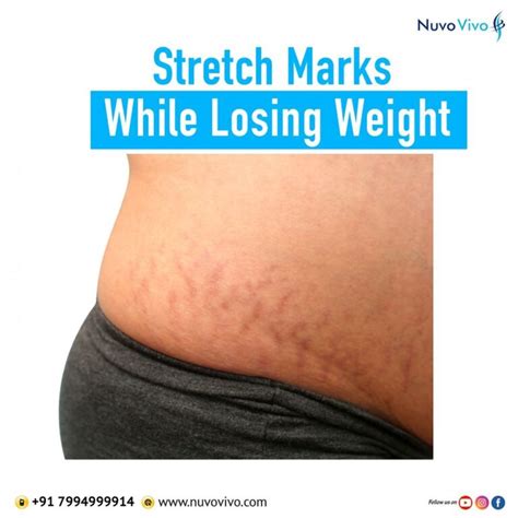 Stretch Marks Diagram Your Uncut Guide To Stretch Mark Cause