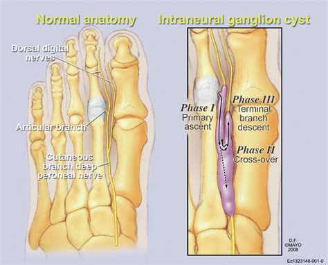 Figure 1 From Magnetic Resonance Imaging Of A Deep Peroneal Intraneural Ganglion Cyst