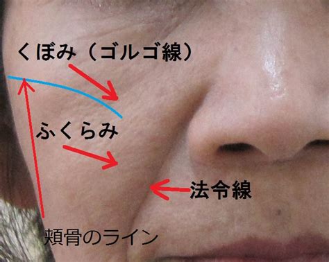 頬のこけの原因と改善方法【形成外科専門医が解説】