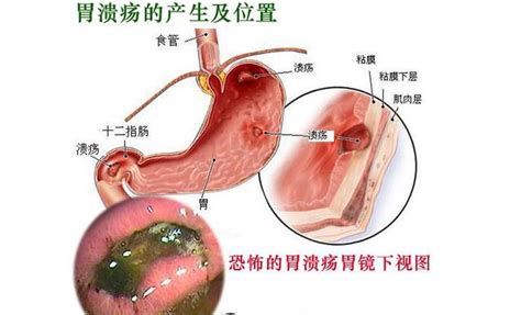 胃溃疡癌变的五大征兆，一定要留心！ 每日头条