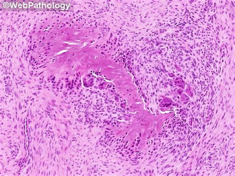 Calcifying Aponeurotic Fibroma Microscopic