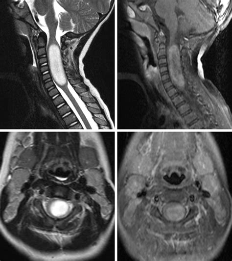 Astrocytoma The Neurosurgical Atlas