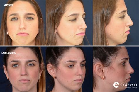 Antes Y Después En Rinoplastia Dr Emilio Cabrera