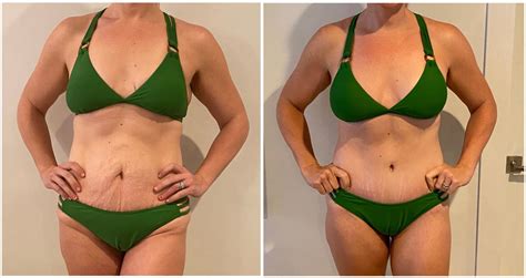 Combining Procedures With A Tummy Tuck Benefits Of A Mommy Makeover In