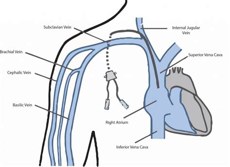 Central Venous Access Dr Ryan Mcconell