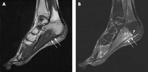 Mri Of Enthesitis Of The Appendicular Skeleton In Spondyloarthritis