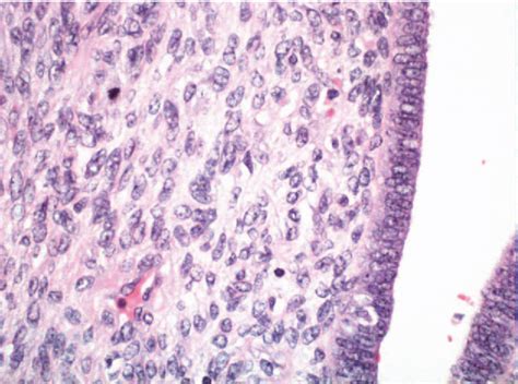 Figure 4 From Uterine Sarcoma A Rare Cause Of Uterine Inversion