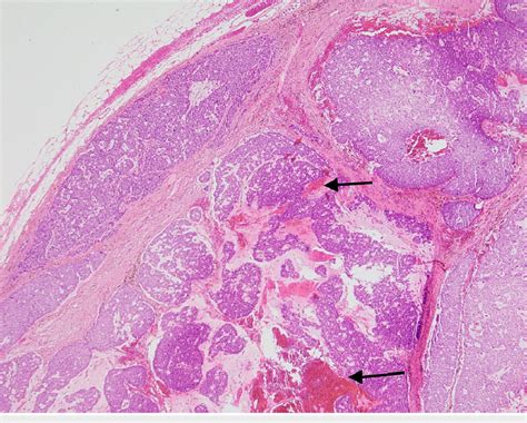 Large Circumscribed Nodular Tumor Occupying Almost Full Thickness Of