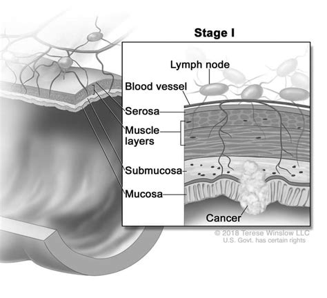 Rectal Cancer Stage 1 - XpertPatient